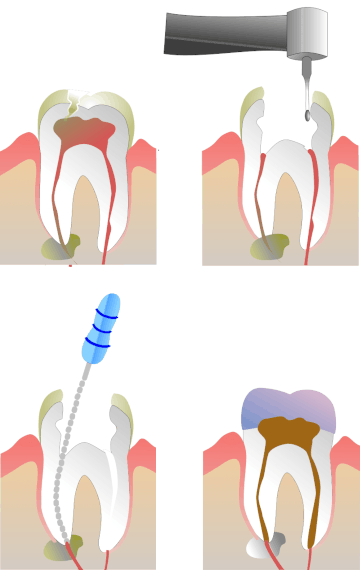Endodoncja - leczenie kanałowe Gliwice