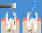 endodoncja gliwice