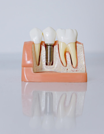 Implanty stomatologiczne Gliwice