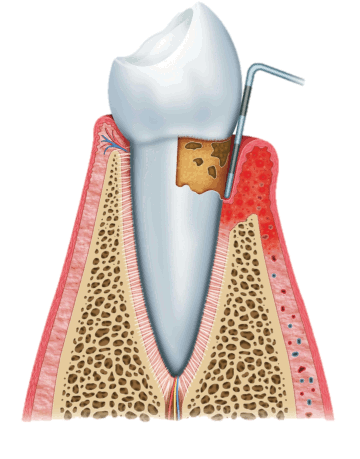 Leczenie paradontozy Gliwice